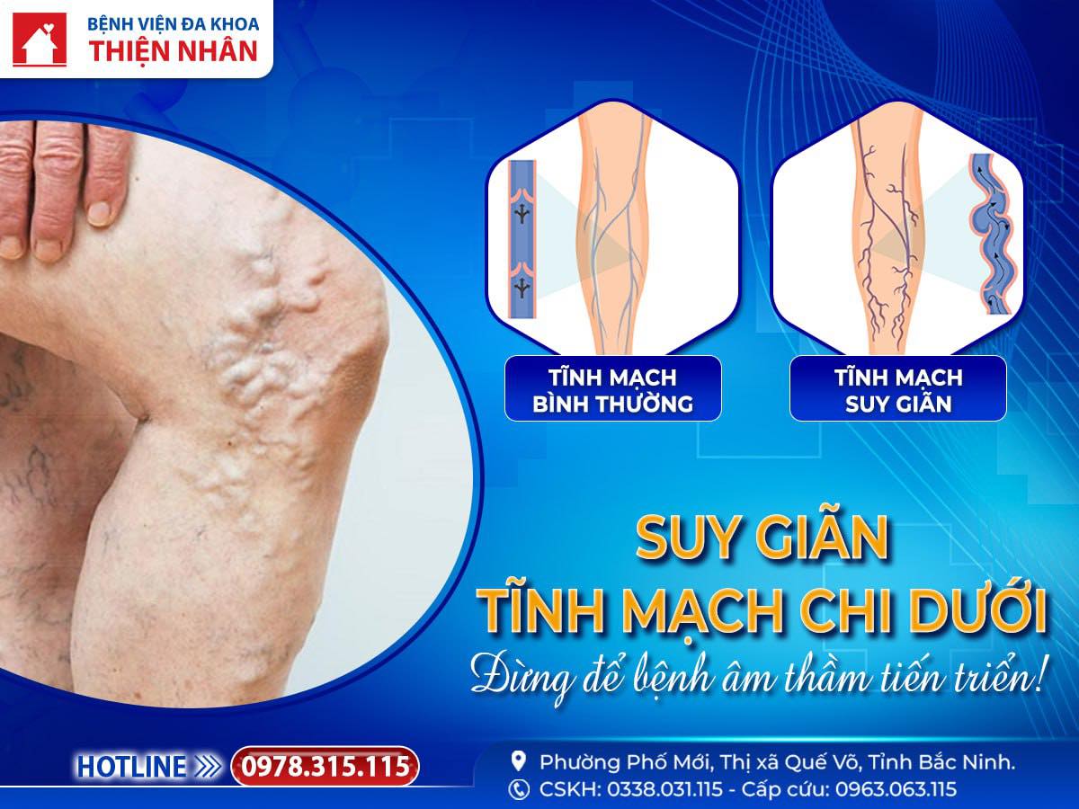 https://benhvienthiennhan.com/suy-gian-tinh-mach-chi-duoi-dung-de-benh-am-tham-tien-trien
