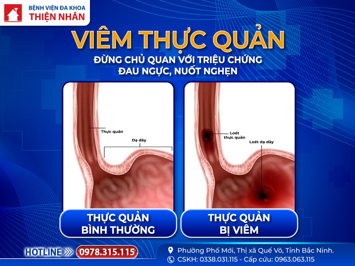 https://benhvienthiennhan.com/viem-thuc-quan-nguyen-nhan-trieu-chung-va-cach-dieu-tri